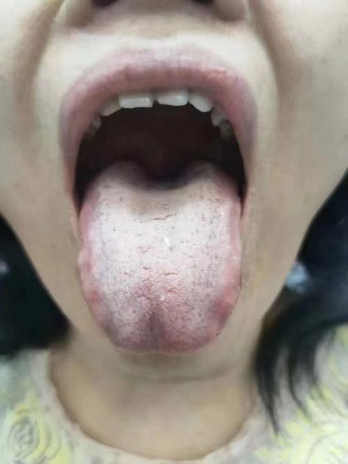 新澳天天彩免费大全和舌根和牙龈被缝一起与舌根和牙龈被缝一起怎么办