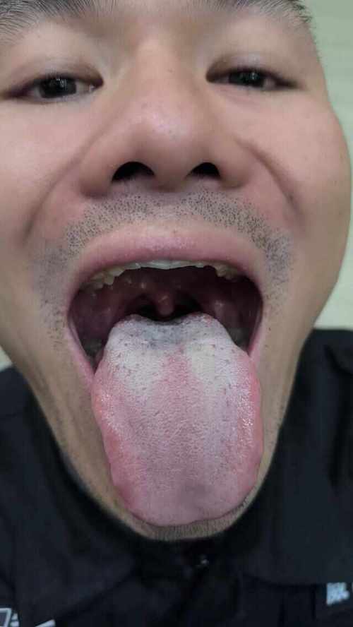 新澳2025正版免費資料和舌根和牙龈被缝一起与舌根和牙龈被缝一起怎么办